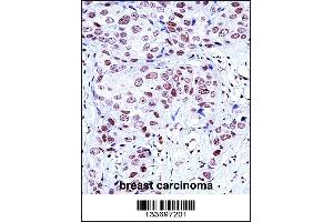 NCK1 Antibody immunohistochemistry analysis in formalin fixed and paraffin embedded human breast carcinoma followed by peroxidase conjugation of the secondary antibody and DAB staining. (NCK1 anticorps  (N-Term))