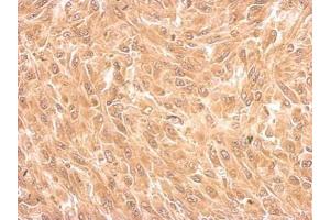 IHC-P Image Filamin B antibody [N1], N-term detects FLNB protein at cytosol on U87 xenograft by immunohistochemical analysis.