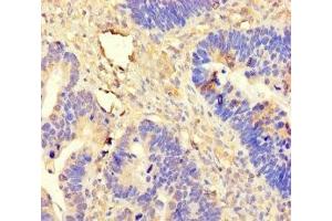 Immunohistochemistry of paraffin-embedded human ovarian cancer using ABIN7144980 at dilution of 1:100 (DDX19A anticorps  (AA 1-478))