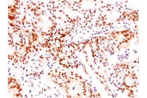 Formalin-fixed, paraffin-embedded human Ovarian Carcinoma stained with ER-beta1 Mouse Monoclonal Antibody (ERb455). (ESR2 anticorps  (C-Term))