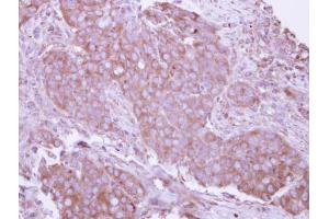 IHC-P Image Immunohistochemical analysis of paraffin-embedded human breast cancer, using CD27, antibody at 1:250 dilution. (CD27 anticorps)