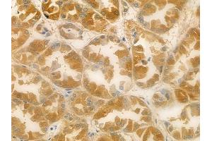 ABIN6257922 and ABIN6274886 at 1/100 staining human renal cell carcinoma by IHC-P.