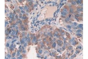 Detection of CFL1 in Human Breast cancer Tissue using Polyclonal Antibody to Cofilin 1 (CFL1)