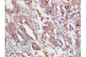 Formalin-fixed and paraffin embedded human lung carcinoma labeled with Rabbit Anti-MKK3(Ser218)/MKK6(Ser207) Polyclonal Antibody, Unconjugated  at 1:200 followed by conjugation to the secondary antibody and DAB staining (MAP2K3 anticorps  (pSer207))