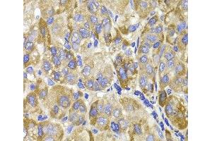 Immunohistochemistry of paraffin-embedded Human liver cancer using MAGED1 Polyclonal Antibody at dilution of 1:100 (40x lens). (MAGED1 anticorps)