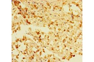 Immunohistochemistry of paraffin-embedded human melanoma using ABIN7166648 at dilution of 1:100 (ACOT6 anticorps  (AA 1-207))