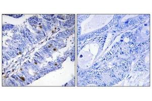 Immunohistochemical analysis of paraffin-embedded human colon carcinoma tissue using Nuclear Receptor NR4A1 (Phospho-Ser351) antibody (left)or the same antibody preincubated with blocking peptide (right). (NR4A1 anticorps  (pSer351))