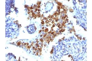 Formalin-fixed, paraffin-embedded human Lung Adenocarcinoma stained with Napsin A Mouse Monoclonal Antibody (NAPSA/1238).
