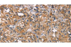 Immunohistochemistry of paraffin-embedded Human thyroid cancer tissue using CEACAM6 Polyclonal Antibody at dilution 1:50 (CEACAM6 anticorps)