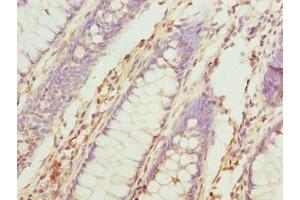 Immunohistochemistry of paraffin-embedded human colon cancer using ABIN7173695 at dilution of 1:100 (TUBb6 anticorps  (AA 1-446))