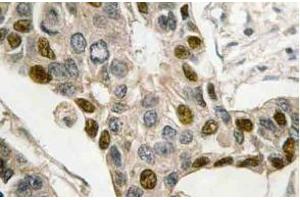 Immunohistochemistry (IHC) analyzes of c-Myb antibody in paraffin-embedded human breast carcinoma tissue. (MYB anticorps)