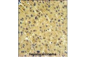 PSL Antibody (Center) (ABIN651259 and ABIN2840158) IHC analysis in forlin fixed and paraffin embedded hepatocarcino followed by peroxidase conjugation of the secondary antibody and DAB staining.