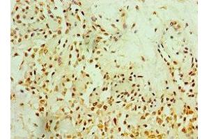 Immunohistochemistry of paraffin-embedded human breast cancer using ABIN7165774 at dilution of 1:100 (MTDH anticorps  (AA 1-260))