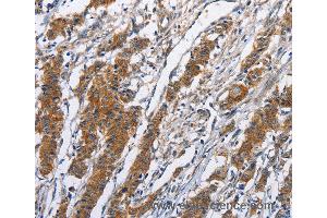 Immunohistochemistry of Human thyroid cancer using NCAPD3 Polyclonal Antibody at dilution of 1:50 (NCAPD3 anticorps)