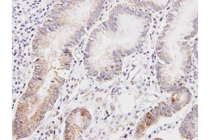 IHC-P Image Immunohistochemical analysis of paraffin-embedded human gastric cancer, using DLD, antibody at 1:100 dilution. (DLD anticorps)
