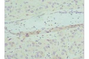 Immunohistochemistry of paraffin-embedded human liver cancer using ABIN7147523 at dilution of 1:100 (CHMP2B anticorps  (AA 1-213))