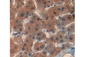 IHC-P analysis of Human Tissue, with DAB staining. (PIBF1 anticorps  (AA 13-203))