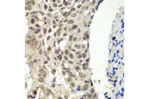 Immunohistochemistry of paraffin-embedded human esophageal cancer using SSRP1 antibody at dilution of 1:100 (x40 lens). (SSRP1 anticorps)