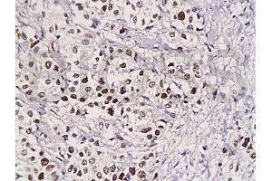 Formalin-fixed and paraffin embedded human gastric carcinoma with Anti-Pokemon Polyclonal Antibody, Unconjugated (ABIN729448) at 1:200, followed by conjugation to the secondary antibody and DAB staining (ZBTB7A anticorps  (AA 151-250))