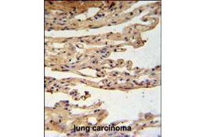 FKBPL Antibody IHC analysis in formalin fixed and paraffin embedded lung carcinoma followed by peroxidase conjugation of the secondary antibody and DAB staining. (FKBPL anticorps  (C-Term))