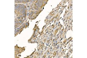 Immunohistochemistry of paraffin-embedded human colon carcinoma using GSDMD (Full Length+N terminal) Rabbit pAb  at dilution of 1:100 (40x lens). (GSDMD anticorps)
