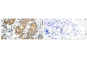 Immunohistochemical analysis of paraffin- embedded human breast carcinoma tissue using GSK3α (Ab-21) antibody (E021007). (GSK3 alpha anticorps)