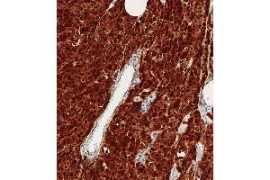 Immunohistochemical analysis of paraffin-embedded Human melanoma tissue using D performed on the Leica® BOND RXm.