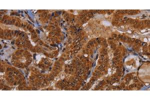 Immunohistochemistry of paraffin-embedded Human thyroid cancer tissue using WDR83 Polyclonal Antibody at dilution 1:60 (MORG1 anticorps)