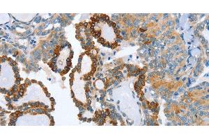Immunohistochemistry of paraffin-embedded Human thyroid cancer tissue using AIP Polyclonal Antibody at dilution 1:80 (AIP anticorps)