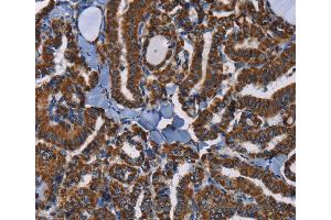 Immunohistochemistry of Human colon cancer using ADRBK2 Polyclonal Antibody at dilution of 1:40 (ADRBK2 anticorps)