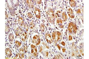 Formalin-fixed and paraffin embedded human gastric carcinoma labeled with Anti-MACC1 Polyclonal Antibody, Unconjugated (ABIN706526) at 1:200 followed by conjugation to the secondary antibody and DAB staining (MACC1 anticorps  (AA 761-852))
