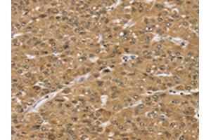 The image on the left is immunohistochemistry of paraffin-embedded Human liver cancer tissue using ABIN7192565(SMC6 Antibody) at dilution 1/30, on the right is treated with synthetic peptide. (SMC6 anticorps)