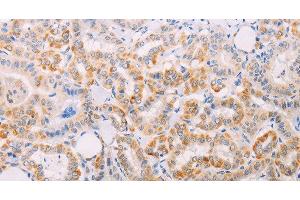 Immunohistochemistry of paraffin-embedded Human thyroid cancer tissue using MAP3K12 Polyclonal Antibody at dilution 1:30 (MAP3K12 anticorps)