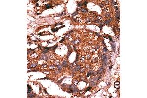 Formalin-fixed and paraffin-embedded human cancer tissue reacted with the primary antibody, which was peroxidase-conjugated to the secondary antibody, followed by AEC staining.