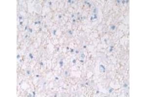 Detection of IL28A in Human Glioma Tissue using Monoclonal Antibody to Interleukin 28A (IL28A)