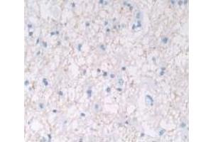 Detection of IL28A in Human Glioma Tissue using Monoclonal Antibody to Interleukin 28A (IL28A) (IL28A anticorps  (AA 26-200))