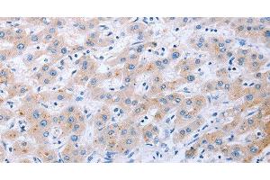 Immunohistochemistry of paraffin-embedded Human liver cancer tissue using FGF4 Polyclonal Antibody at dilution 1:40 (FGF4 anticorps)