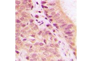 Immunohistochemical analysis of IDH1 staining in human colon cancer formalin fixed paraffin embedded tissue section.