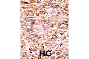 Formalin-fixed and paraffin-embedded human hepatocellular carcinoma tissue reacted with CDKN1B (phospho S178) polyclonal antibody  which was peroxidase-conjugated to the secondary antibody followed by AEC staining. (CDKN1B anticorps  (pSer178))