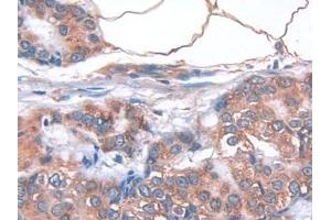 Detection of IL33 in Human Breast cancer Tissue using Monoclonal Antibody to Interleukin 33 (IL33)