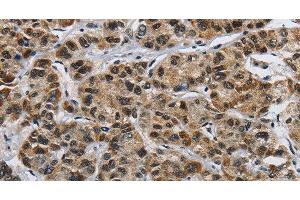 Immunohistochemistry of paraffin-embedded Human liver cancer using HNRNP L Polyclonal Antibody at dilution of 1:40 (HNRNPL anticorps)
