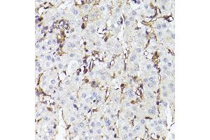 Immunohistochemistry of paraffin-embedded human liver cancer using TLR8 Rabbit pAb (ABIN3022014, ABIN3022015, ABIN3022016, ABIN1513616 and ABIN6218568) at dilution of 1:150 (40x lens). (TLR8 anticorps  (AA 849-1041))