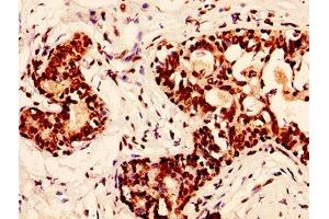 IHC image of nphHU diluted at 1:50 and staining in paraffin-embedded human breast cancer performed on a Leica BondTM system. (H2AFX anticorps)