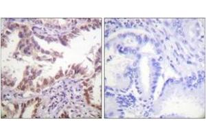 Immunohistochemistry analysis of paraffin-embedded human lung carcinoma tissue, using Histone H3 (Ab-14) Antibody. (Histone 3 anticorps  (AA 6-55))