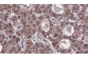 ABIN6273876 at 1/100 staining Human liver cancer tissue by IHC-P. (FFAR2 anticorps  (C-Term))