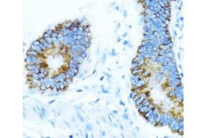 Immunohistochemistry of paraffin-embedded Human colon carcinoma using NOX1 Polyclonal Antibody at dilution of 1:100 (40x lens). (NOX1 anticorps)