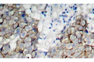Immunohistochemistry of paraffin-embedded Human breast carcinoma using Phospho-IGF1R(Y1161) Polyclonal Antibody (IGF1R anticorps  (pTyr1161))
