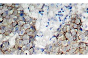 Immunohistochemistry of paraffin-embedded Human breast carcinoma using Phospho-IGF1R(Y1161) Polyclonal Antibody