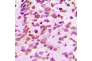 Immunohistochemical analysis of RPC staining in human breast cancer formalin fixed paraffin embedded tissue section.