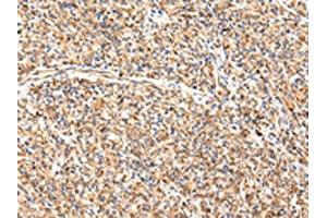 The image on the left is immunohistochemistry of paraffin-embedded Human prostate cancer tissue using ABIN7189649(ADAMTS1 Antibody) at dilution 1/35, on the right is treated with synthetic peptide. (ADAMTS1 anticorps)